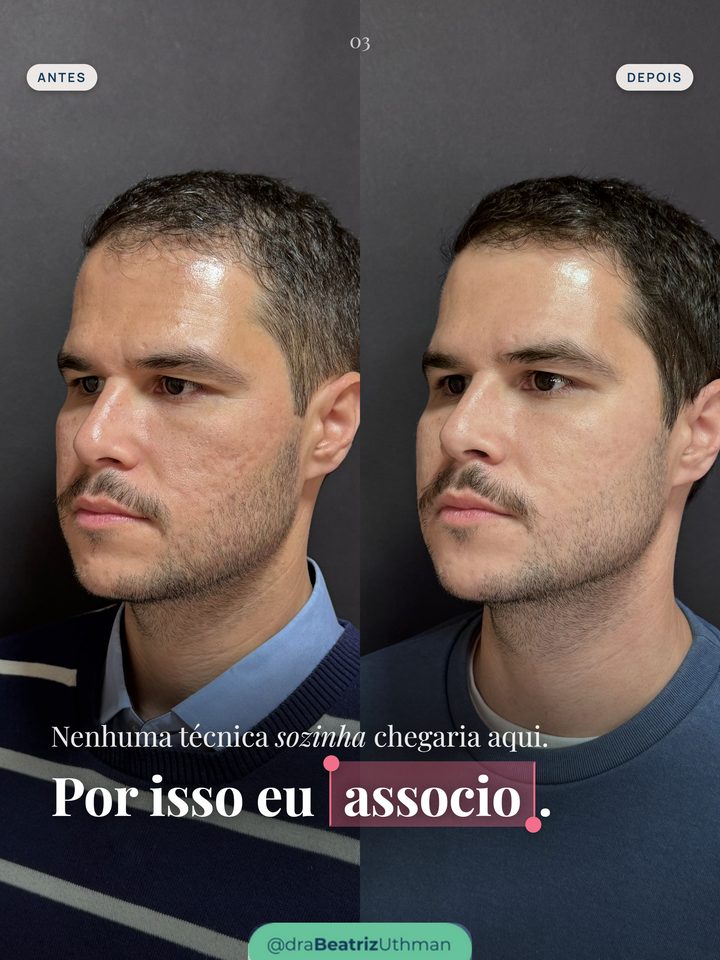 O paciente de perfil, antes e depois: nenhuma técnica sozinha chegaria aqui