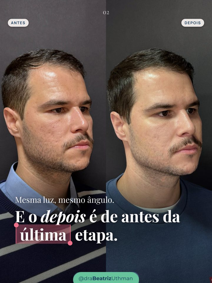 O paciente de perfil, antes e depois, com a mesma luz e o mesmo ângulo; o depois foi fotografado antes da última etapa