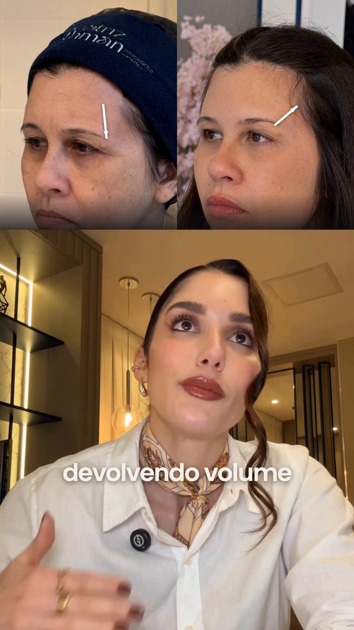 Antes e depois de uma paciente, com setas na cauda da sobrancelha e na têmpora, e a Dra. Beatriz explicando abaixo