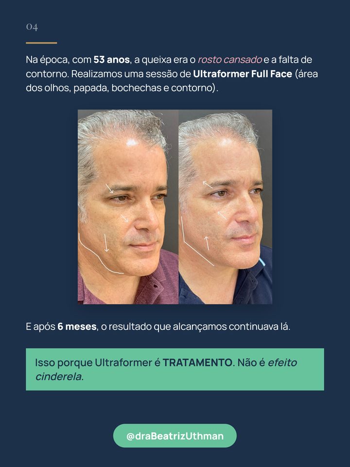 Caso 3: paciente de 53 anos, antes e 6 meses depois de uma sessão de Ultraformer full face