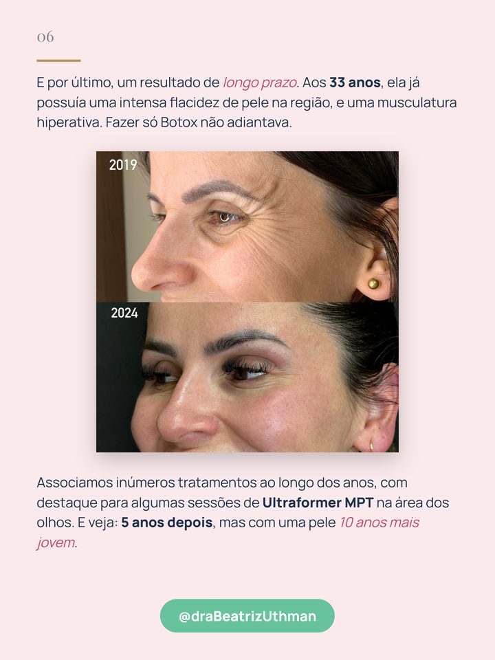 Caso 5: a mesma paciente em 2019 e em 2024, com tratamentos associados e sessões de Ultraformer MPT na área dos olhos