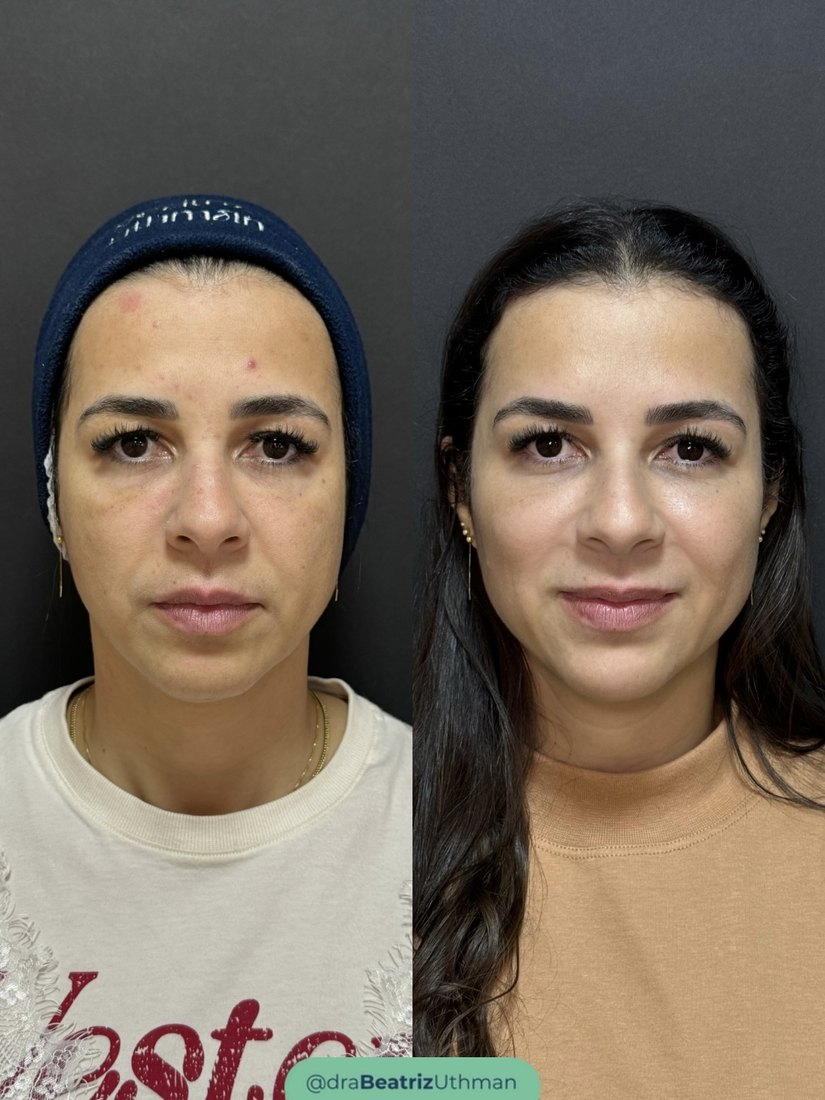 Caso 2 com o Método B.Up: antes e depois