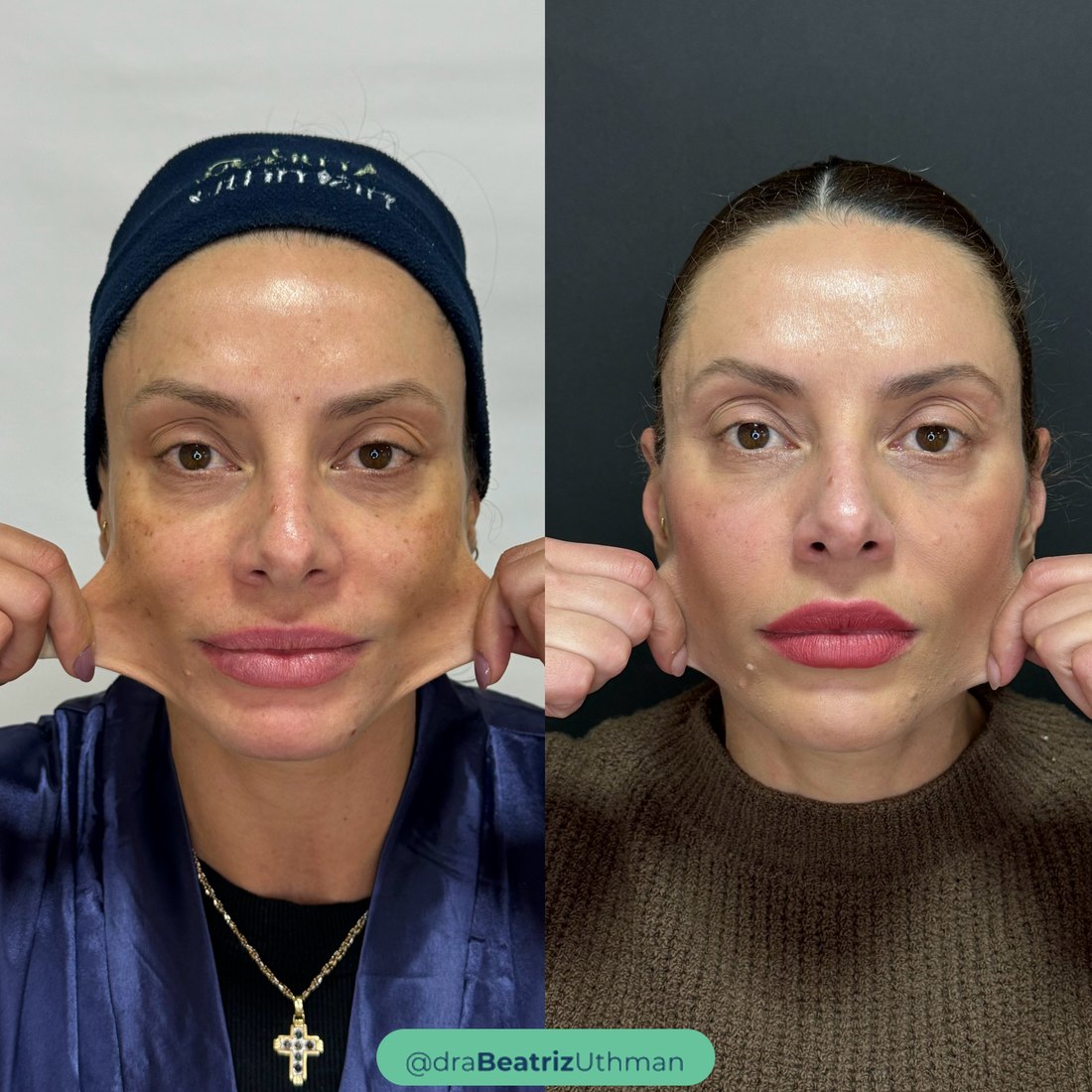 Caso 3 com Bioreconexão e BIOrregenera Intense: antes e depois