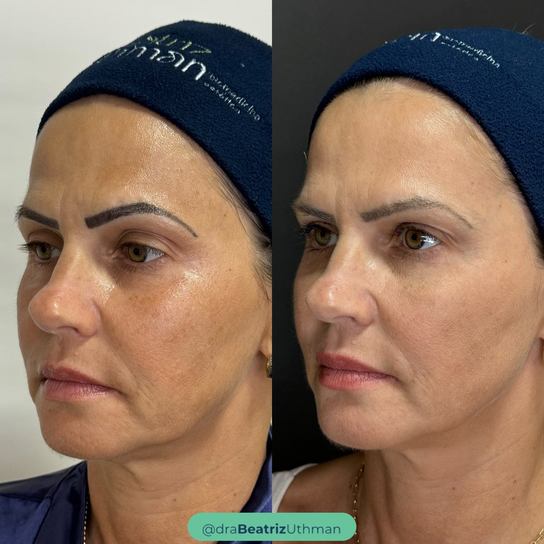 Caso 5 com Bioreconexão: antes e depois