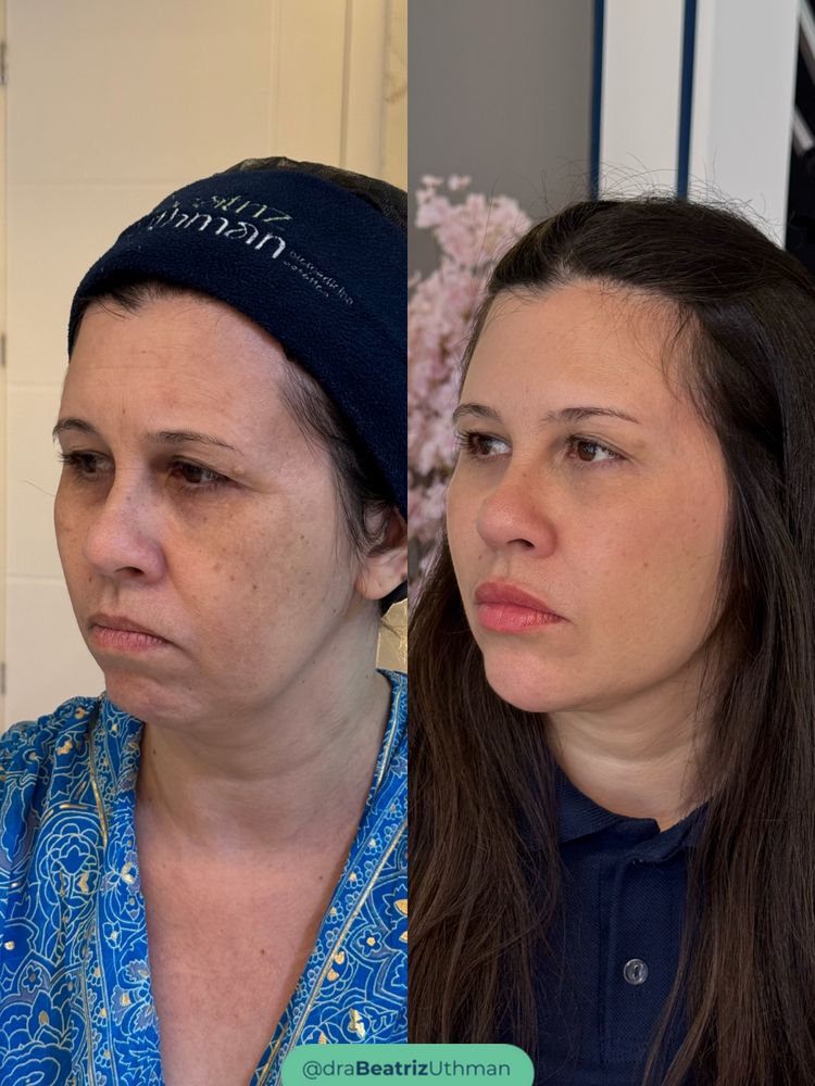 Método B.Up · Caso 2: antes e depois