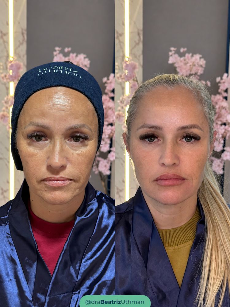 Caso 3 do Método B.Up: antes e depois