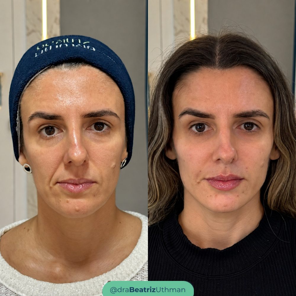 Caso 5 do Método B.Up: antes e depois