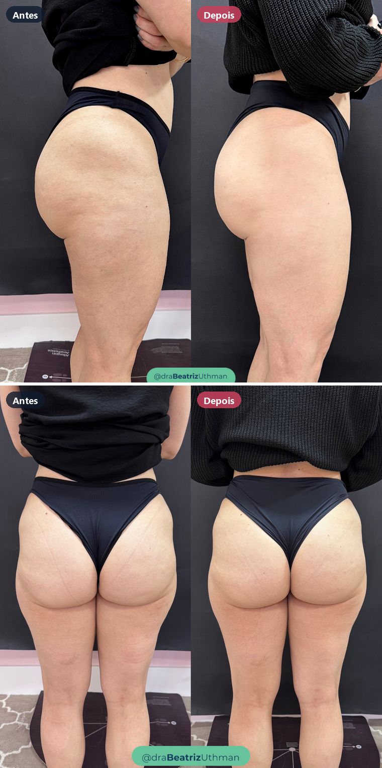 Caso 2, bumbum: antes e depois