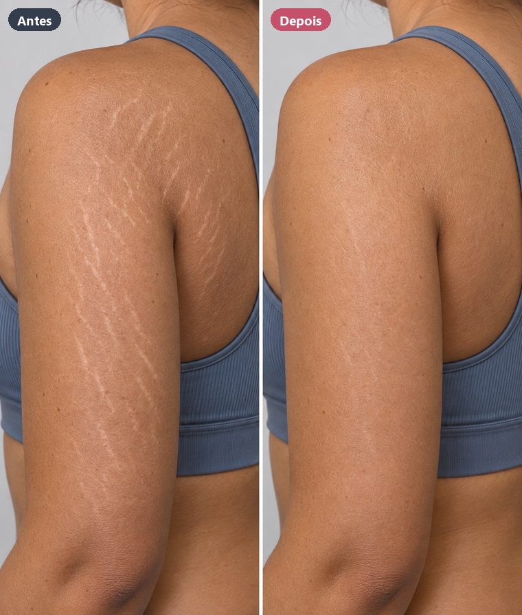 Estrias no braço, antes e depois