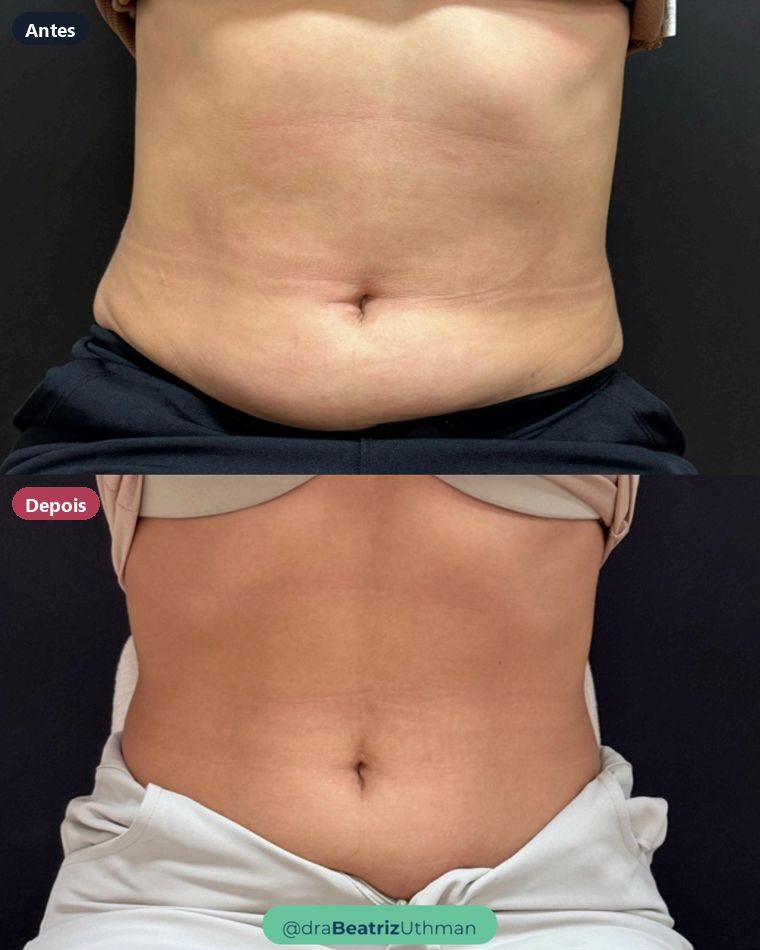 Abdômen de uma paciente do consultório, antes e depois do Shape.Up