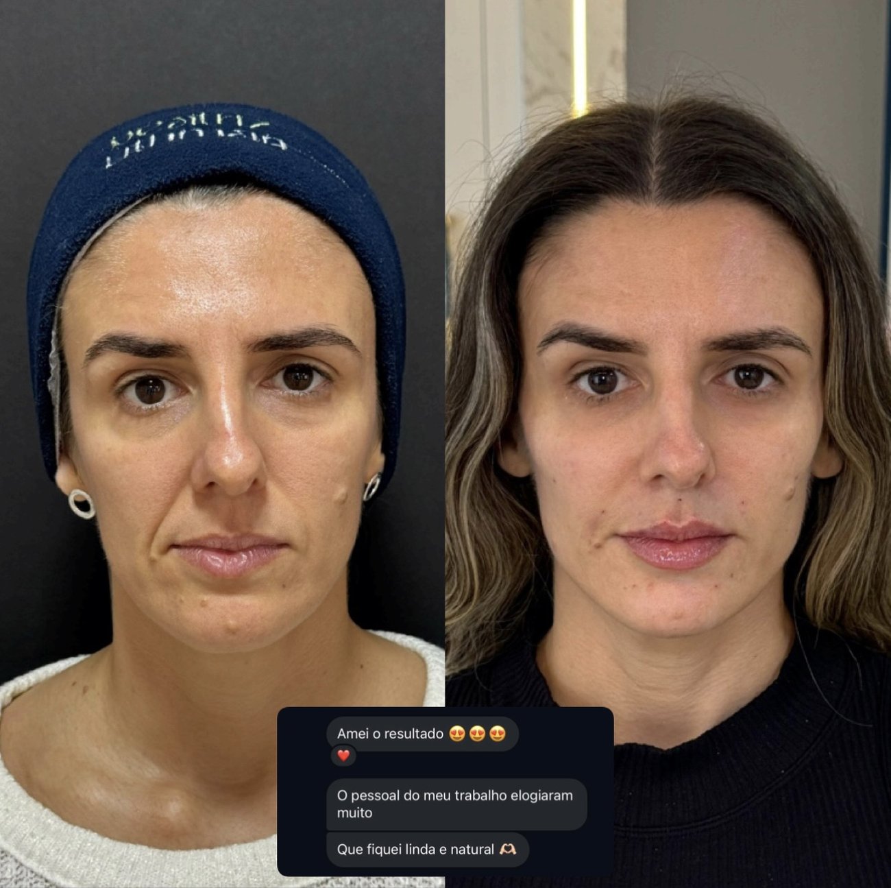 Antes e depois de uma paciente, com o depoimento dela sobre o resultado