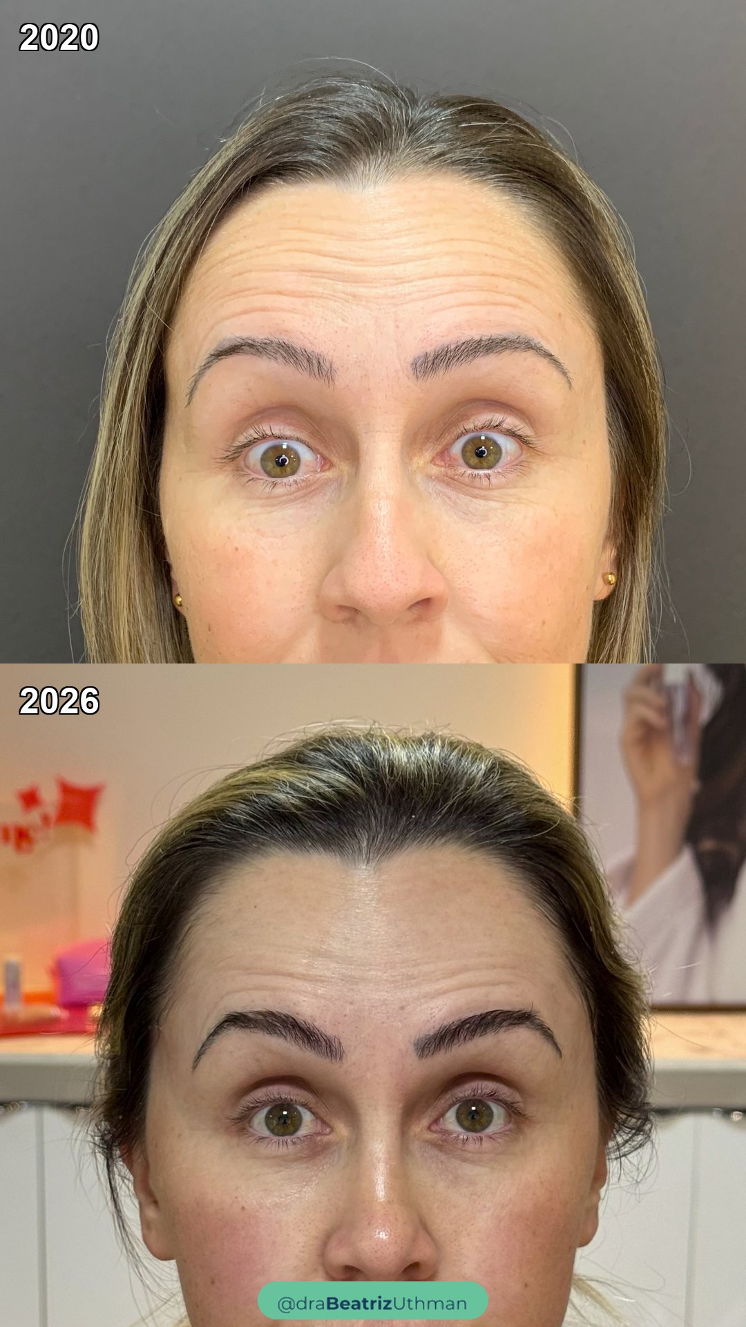 Paciente em 2020 e em 2026, sem o efeito da toxina nas duas fotos