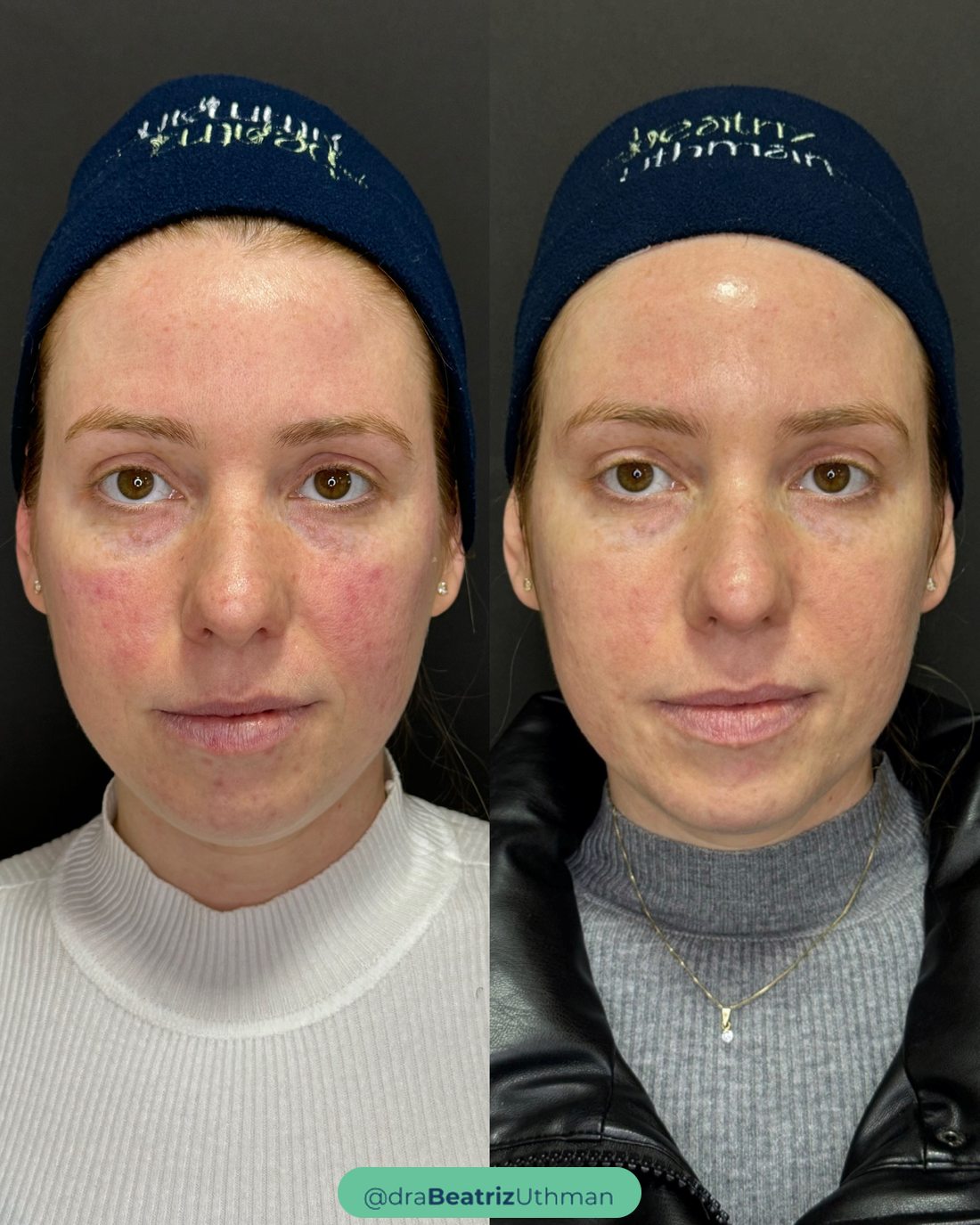 Rosácea antes e depois do microbotox: a vermelhidão das bochechas diminuiu