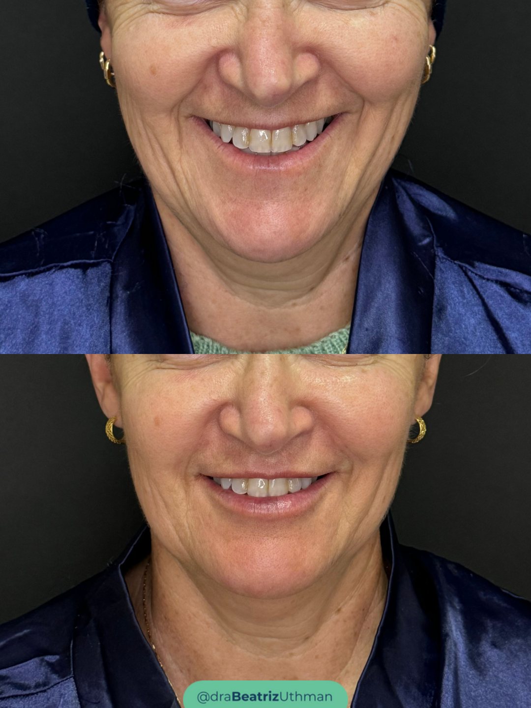 Paciente antes (em cima) e depois (embaixo): contorno do rosto mais definido e pele do pescoço mais lisa