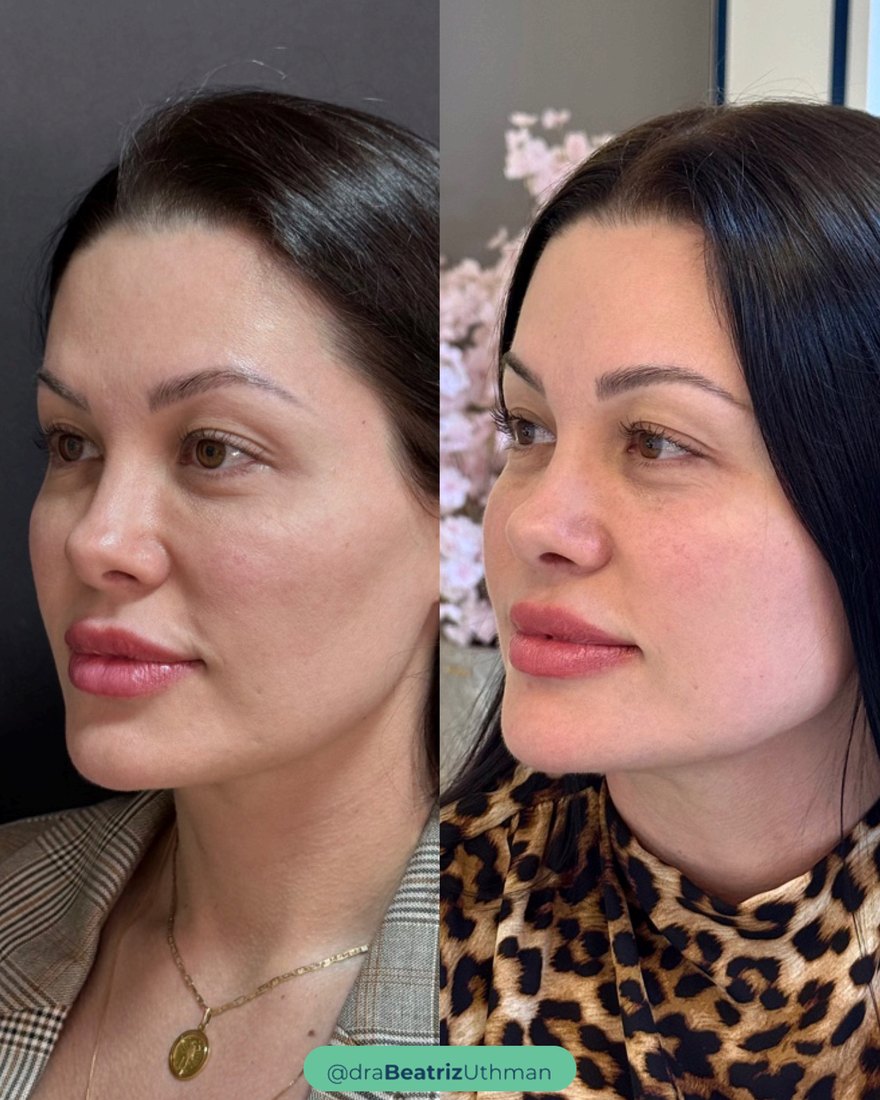 Caso 2 com Protocoll: antes e depois
