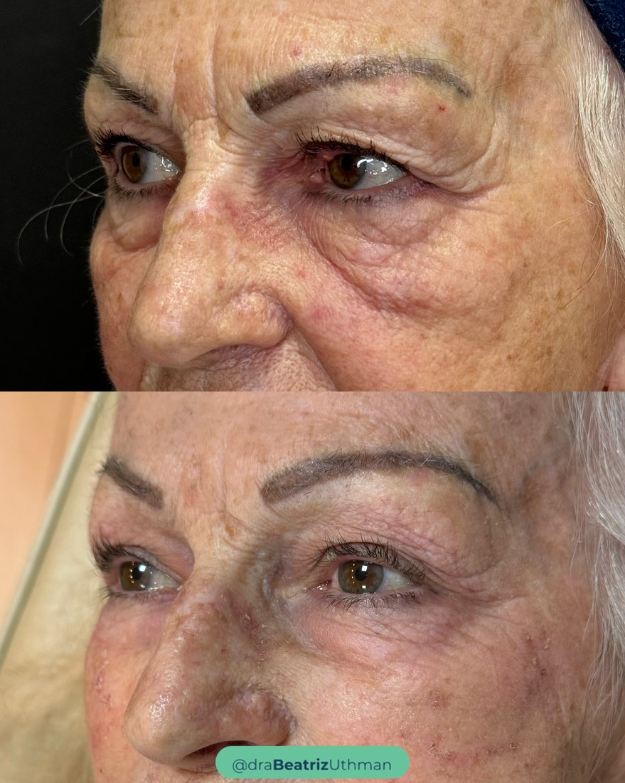 Resultado do Protocoll na área dos olhos: antes e depois