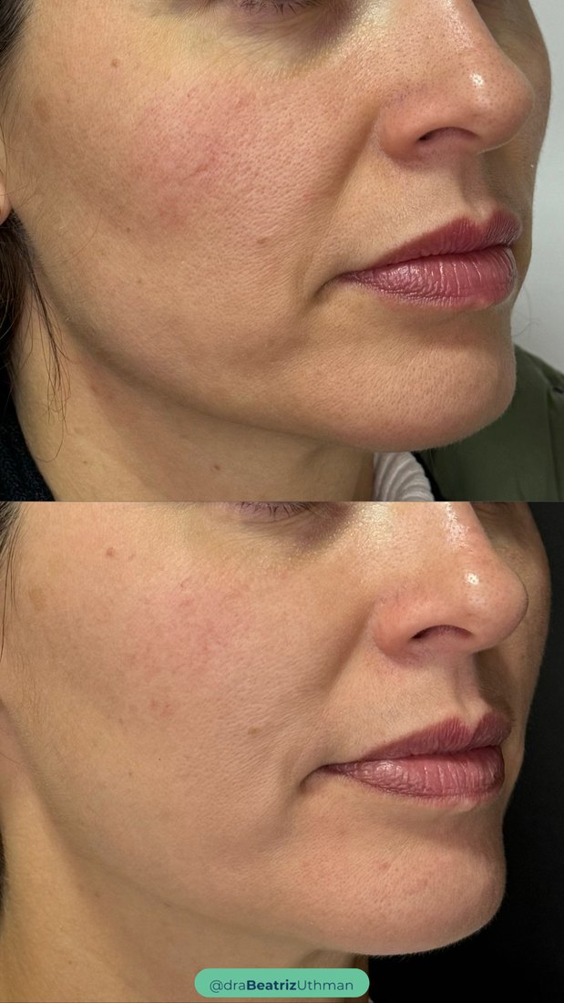 Caso 3 com Protocoll: antes e depois