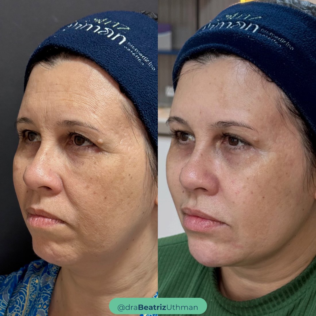 Caso 5 com Protocoll: antes e depois