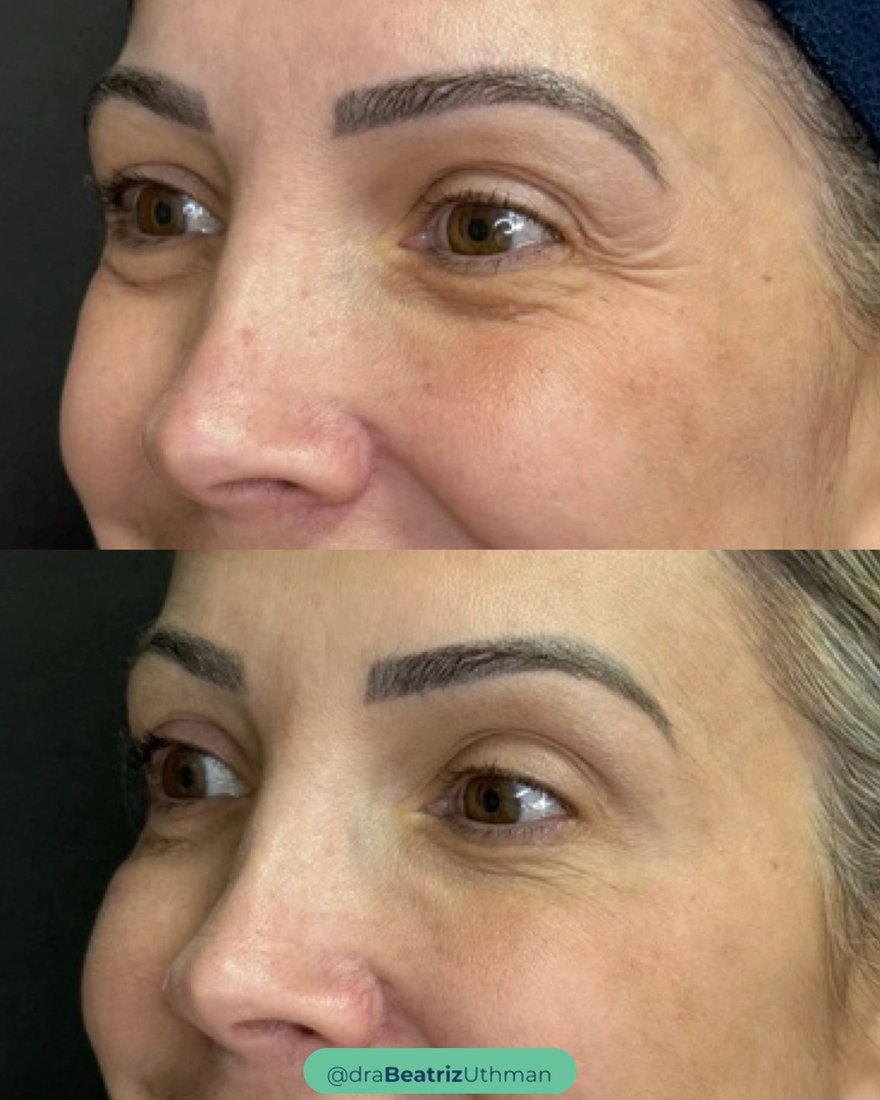 Caso 1, área dos olhos: antes e depois