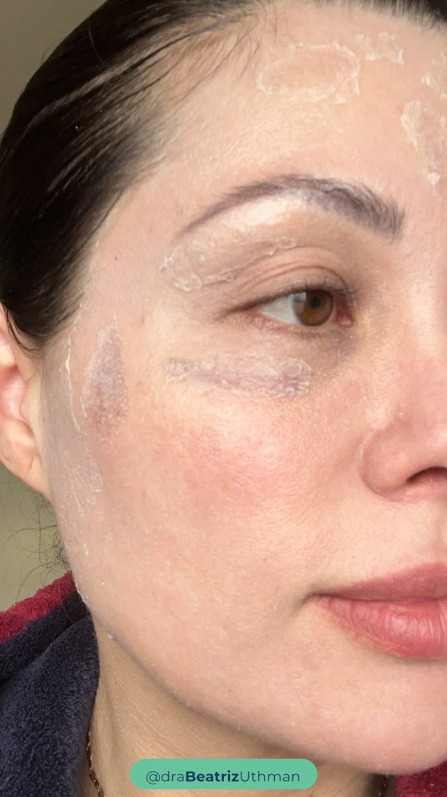 7º dia depois do Protocoll: descamação na testa e ao redor dos olhos