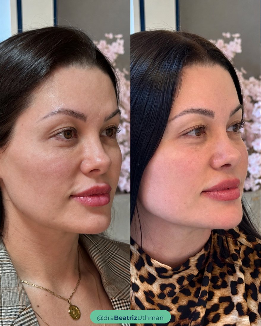 Resultado do Protocoll na mesma paciente: antes e depois