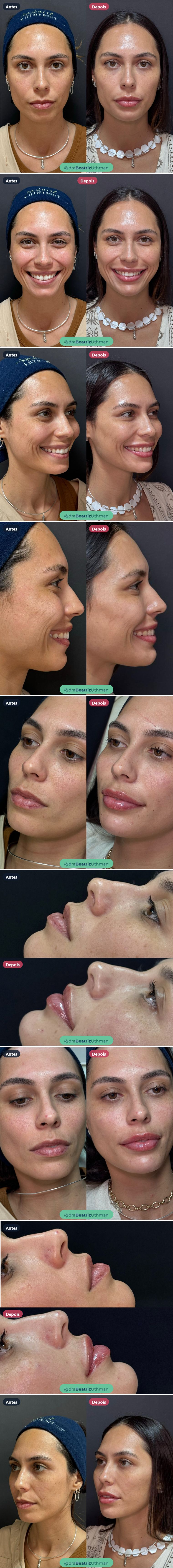 Caso 2 de harmonização com preenchimento: antes e depois