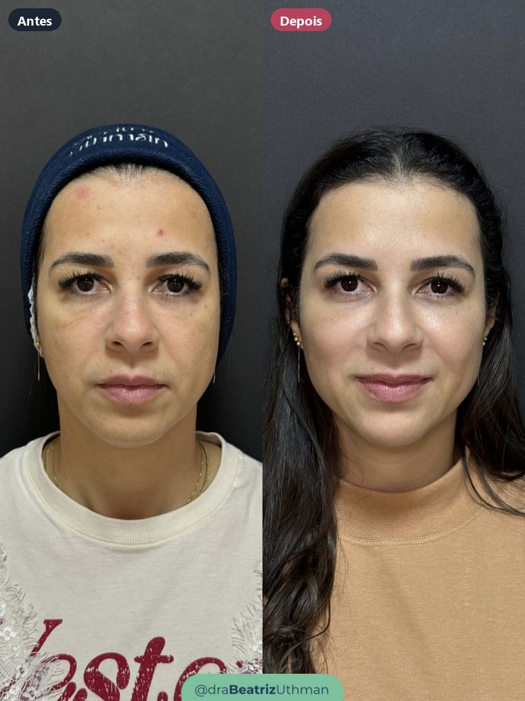 Caso 3 de harmonização com preenchimento: antes e depois