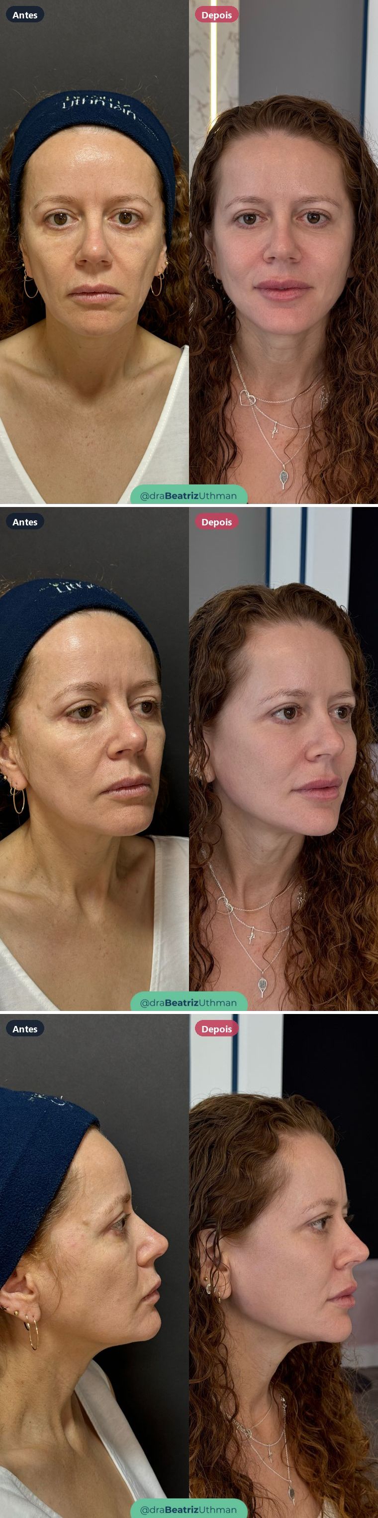 Caso 5 de harmonização com preenchimento: antes e depois