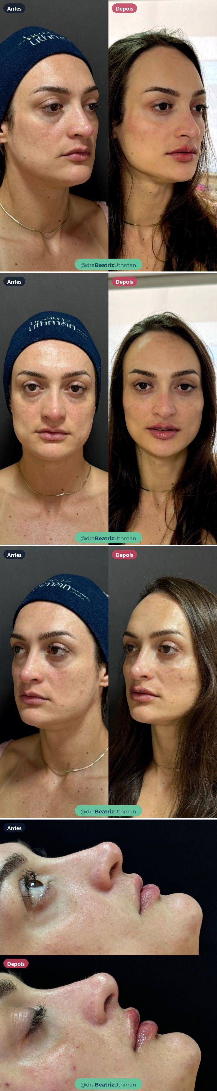 Caso 7 de harmonização com preenchimento: antes e depois