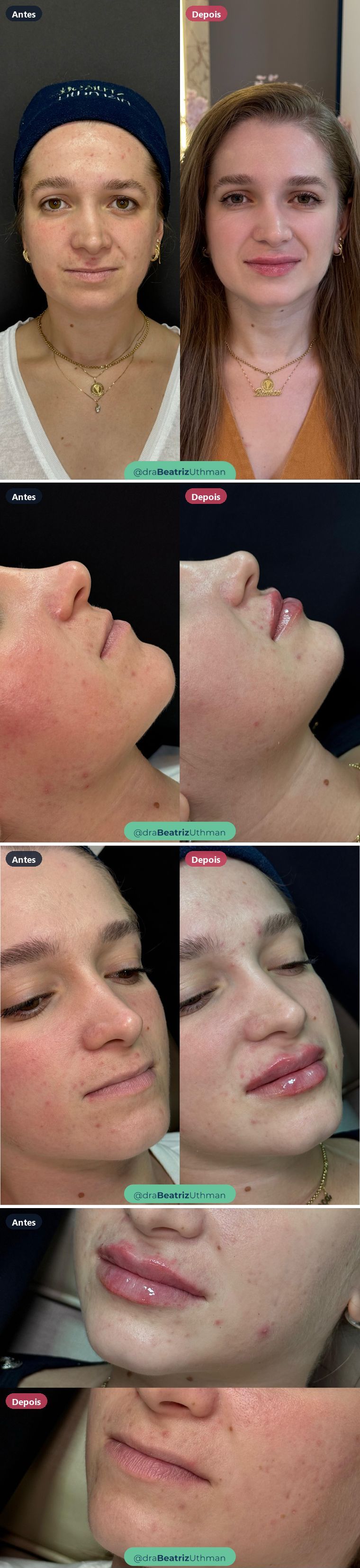 Caso 6 de preenchimento labial: antes e depois