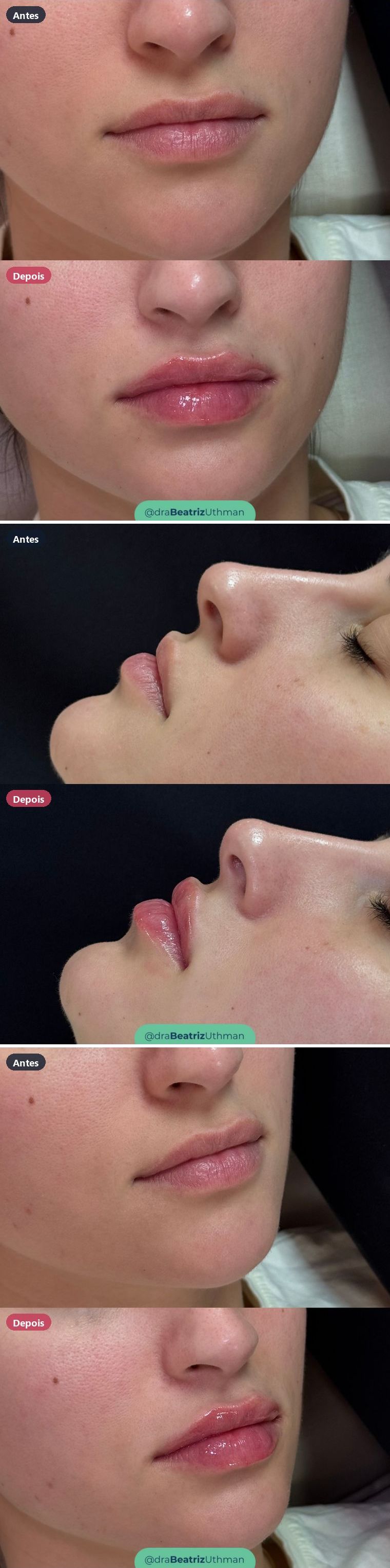 Caso 3 de preenchimento labial: antes e depois