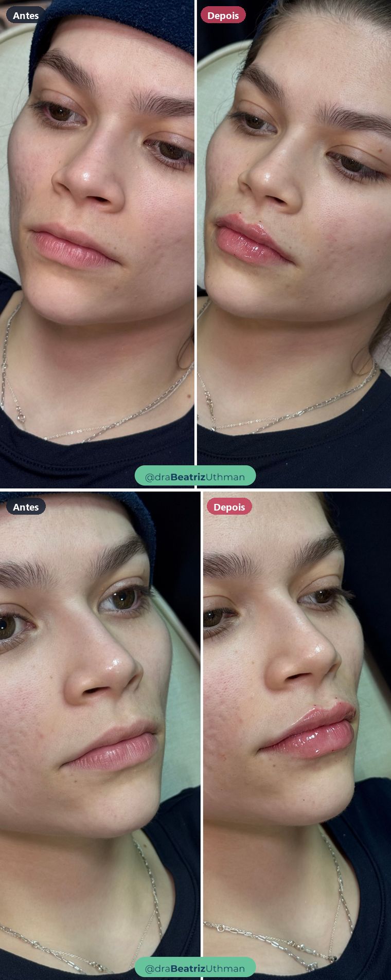 Caso 5 de preenchimento labial: antes e depois