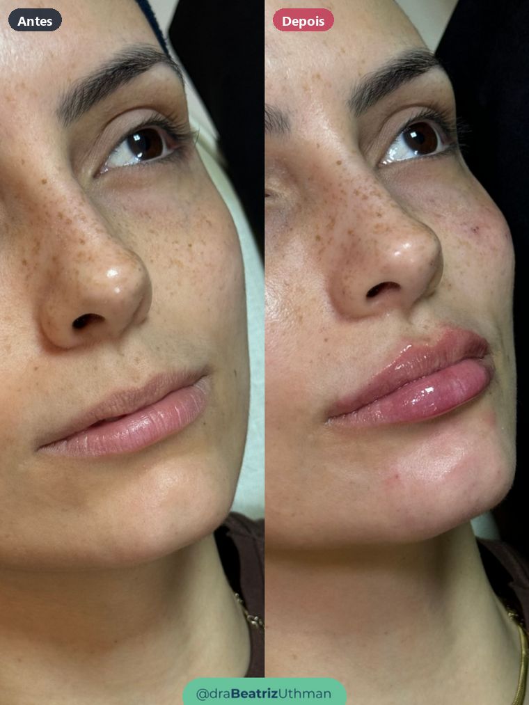Caso 4 de preenchimento labial: antes e depois