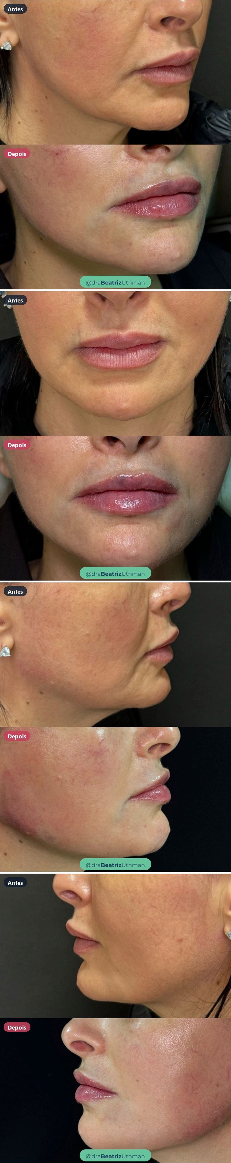 Caso 7 de preenchimento labial: antes e depois