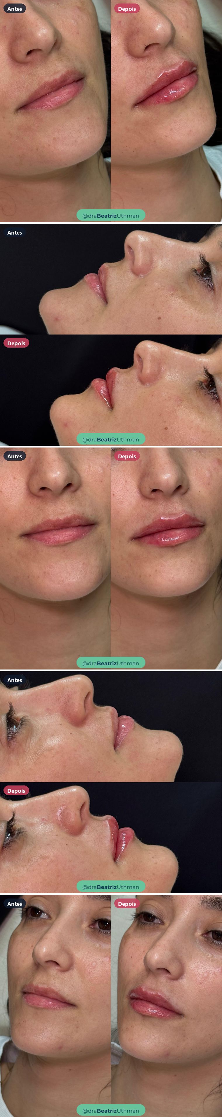 Caso 8 de preenchimento labial: antes e depois