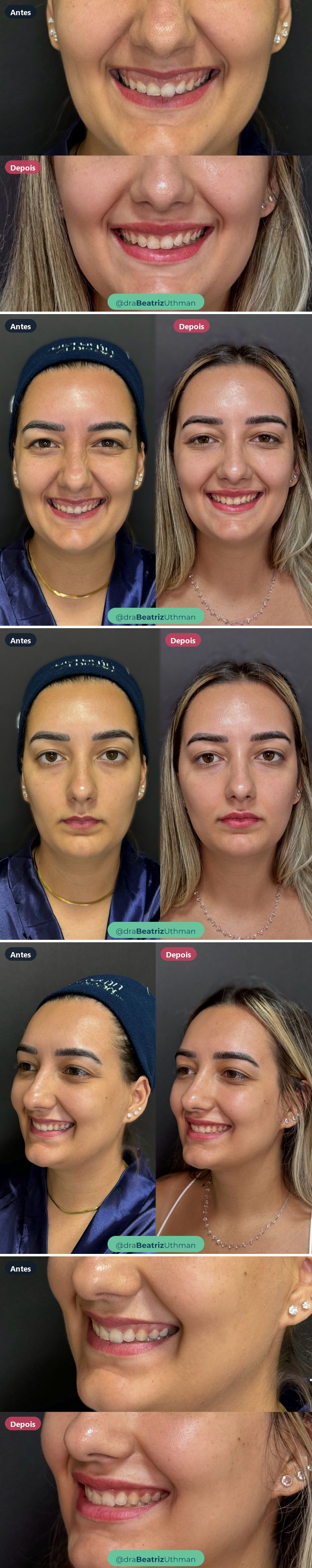 Caso 9 de preenchimento labial: antes e depois