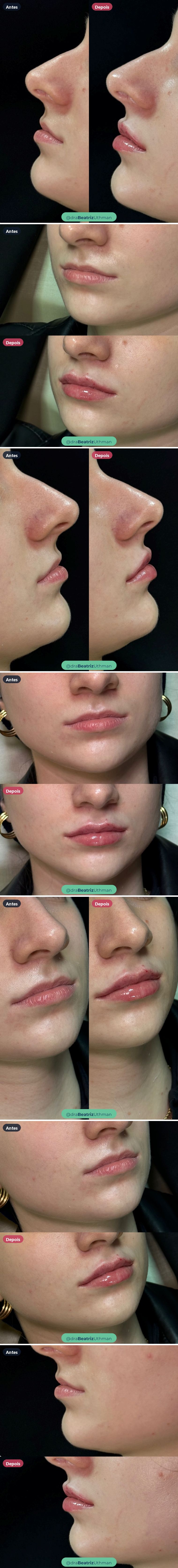 Caso 10 de preenchimento labial: antes e depois