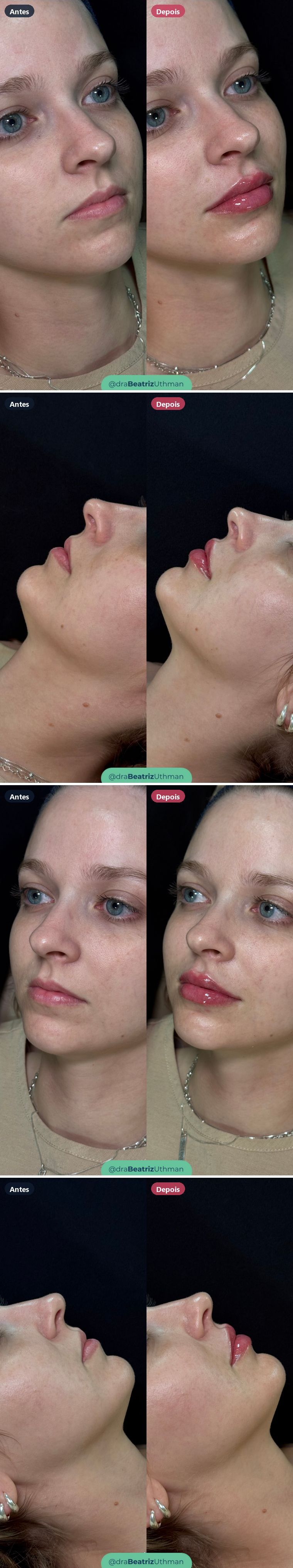 Caso 1 de preenchimento labial: antes e depois