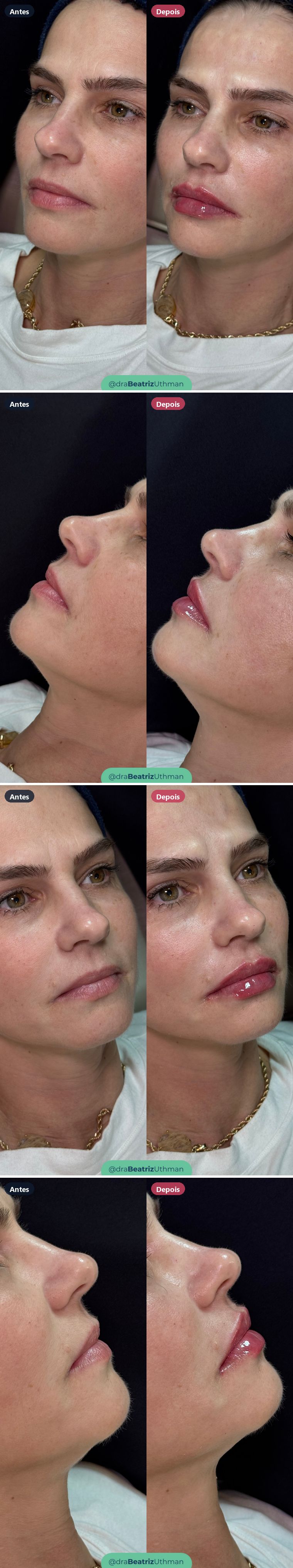 Caso 2 de preenchimento labial: antes e depois