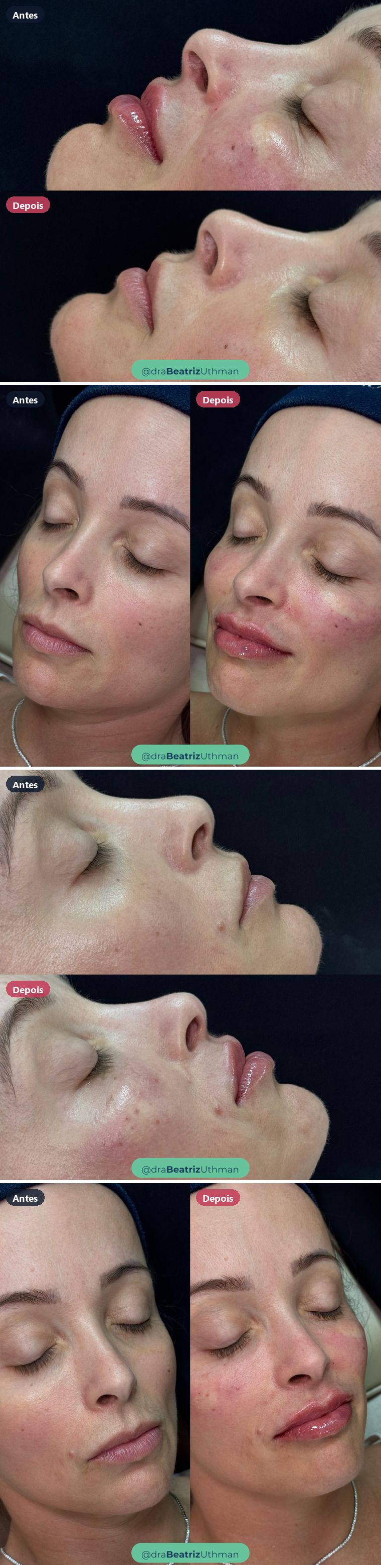 Caso 11 de preenchimento labial: antes e depois