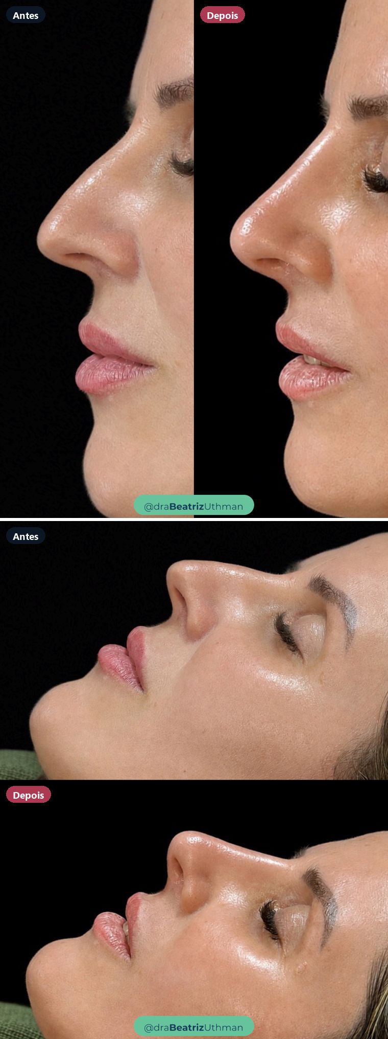Caso 3 de rinomodelação: antes e depois