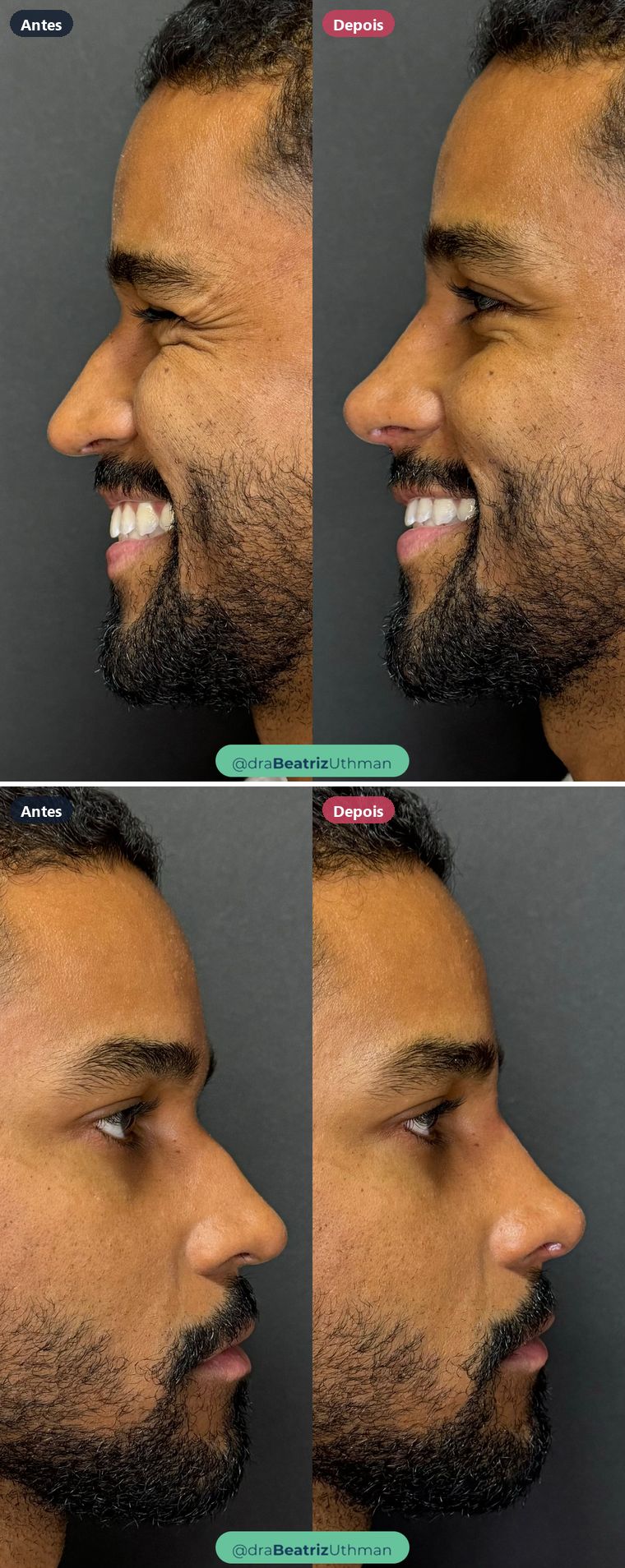 Caso 5 de rinomodelação: antes e depois