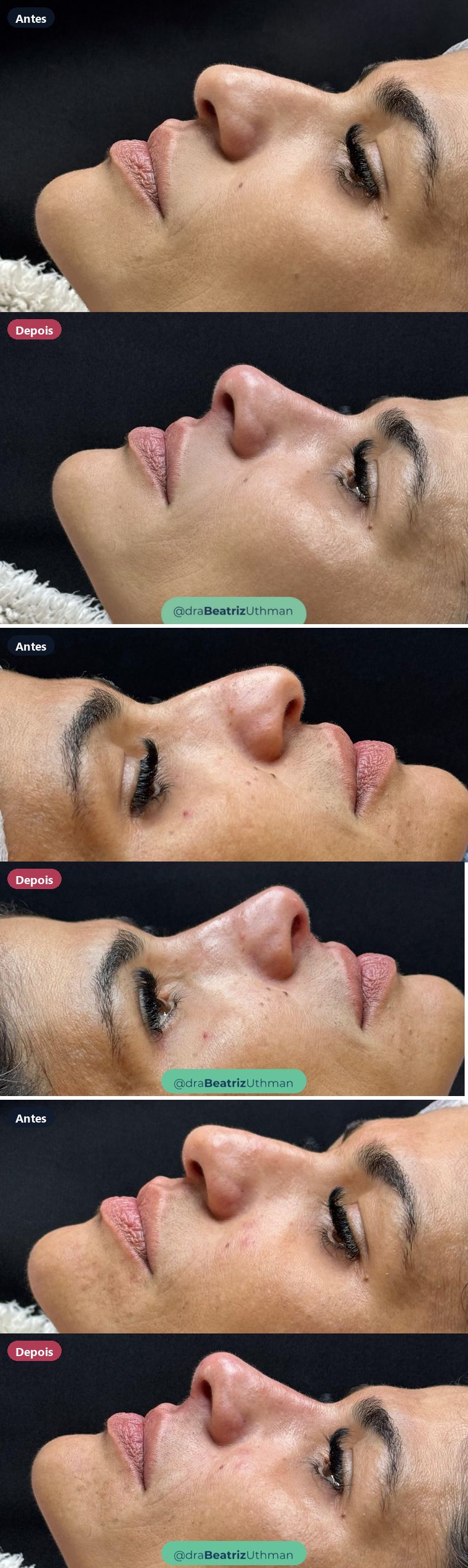 Caso 10 de rinomodelação: antes e depois