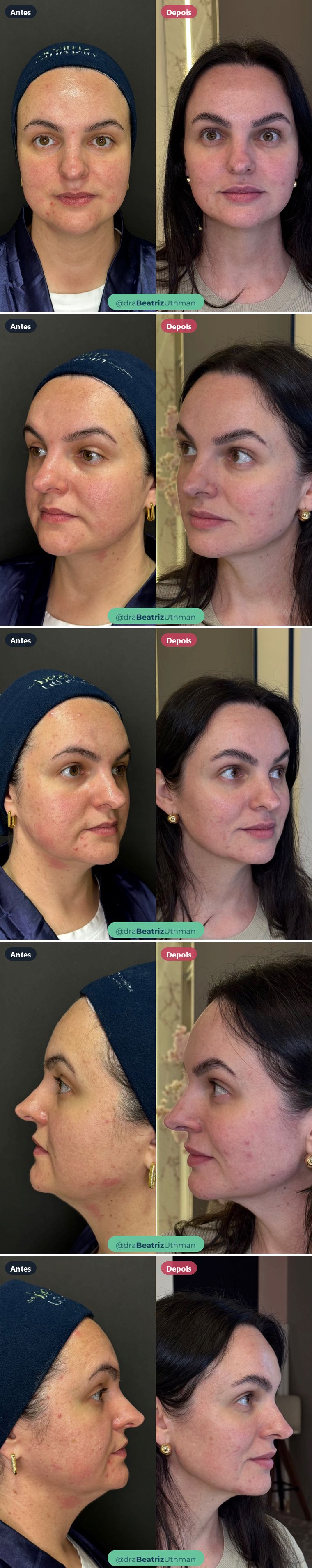 Caso 1 com Ultraformer, afinamento facial: antes e depois