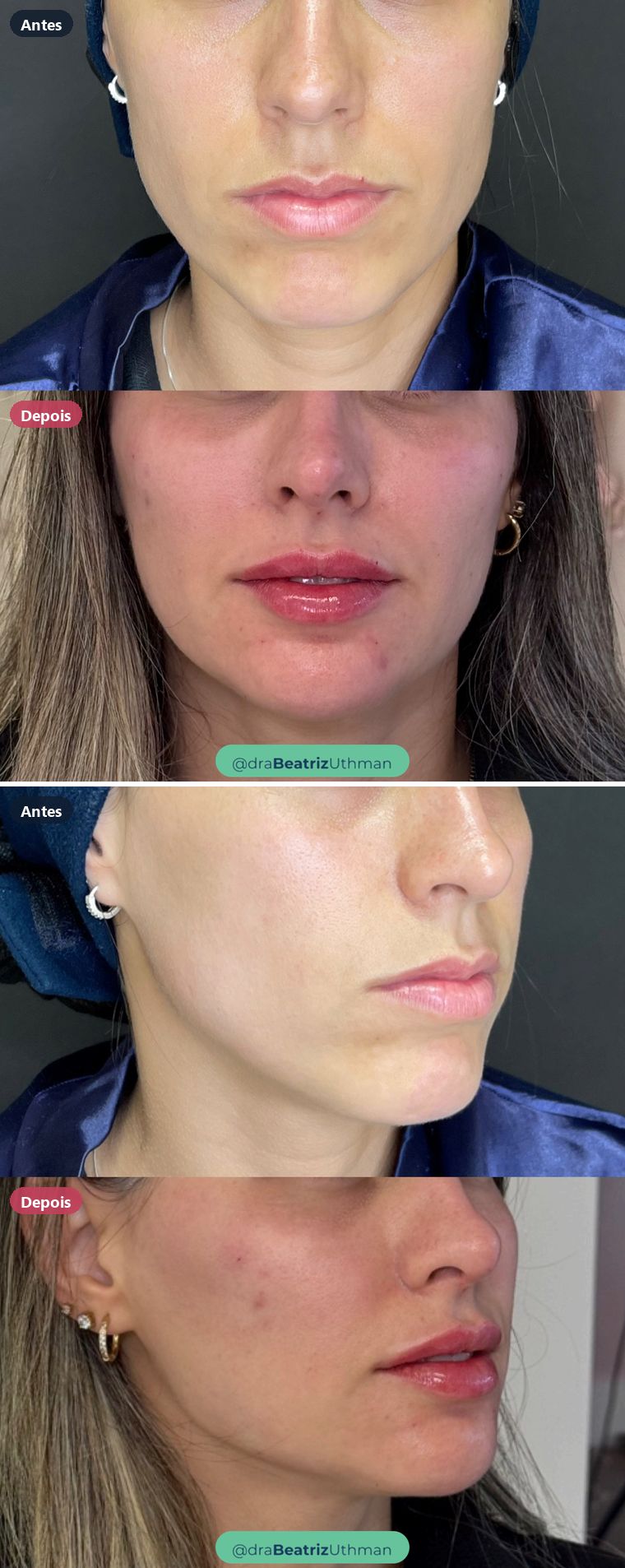 Caso 1 de harmonização com preenchimento: antes e depois
