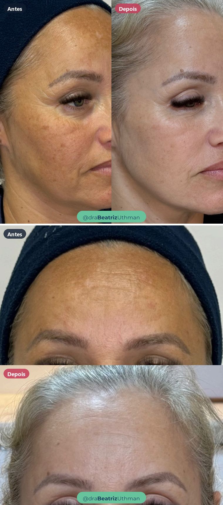 Caso de melasma: antes e depois