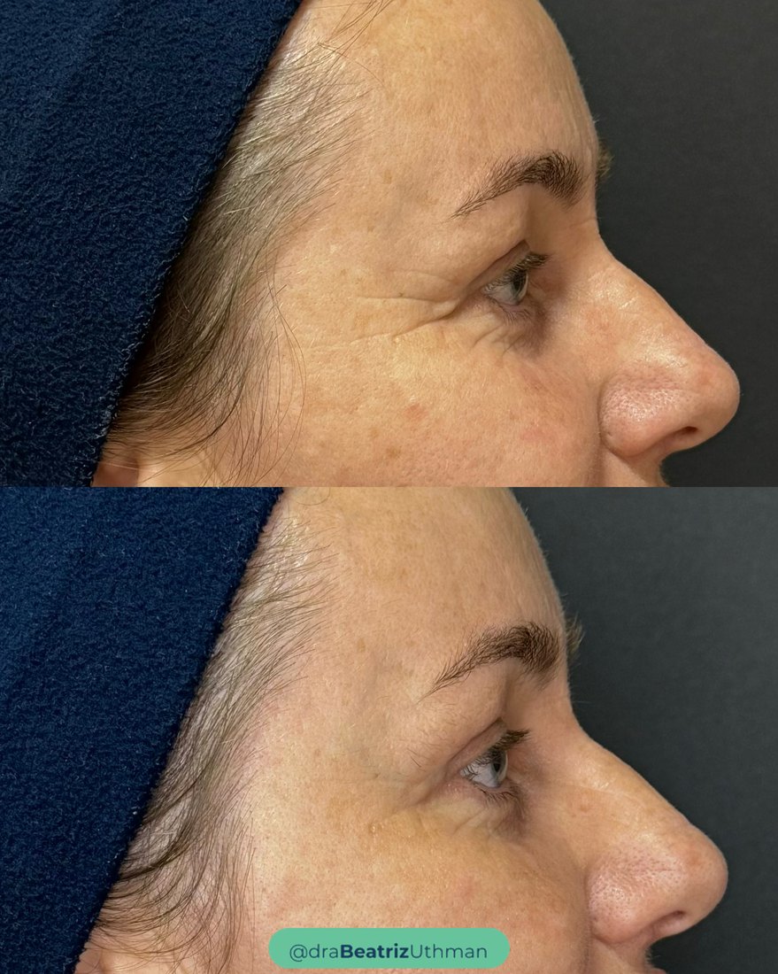 Caso com Exo.coll na área dos olhos: antes e depois