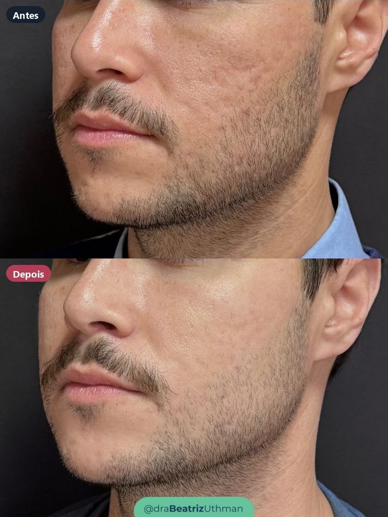 Cicatrizes de acne · Caso 1: antes e depois
