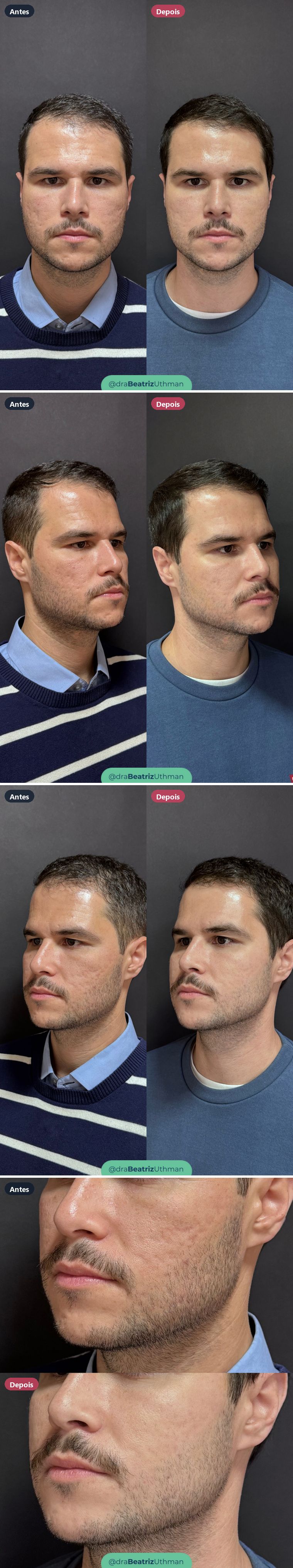 Cicatrizes de acne · Caso 1: antes e depois