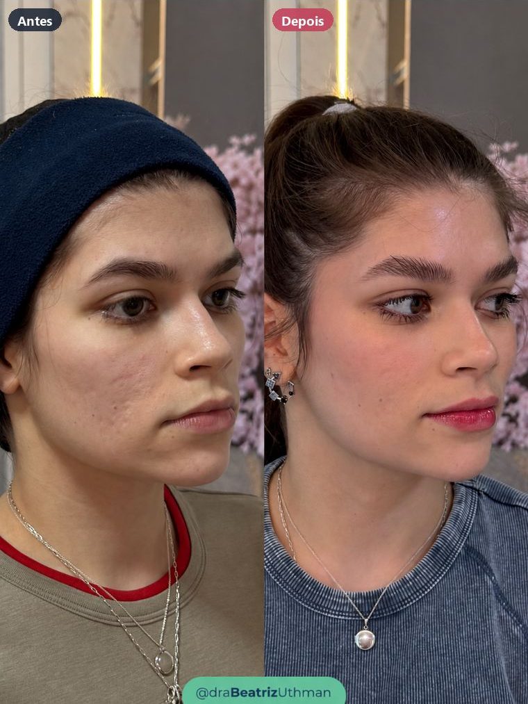 Cicatrizes de acne · Caso 2: antes e depois